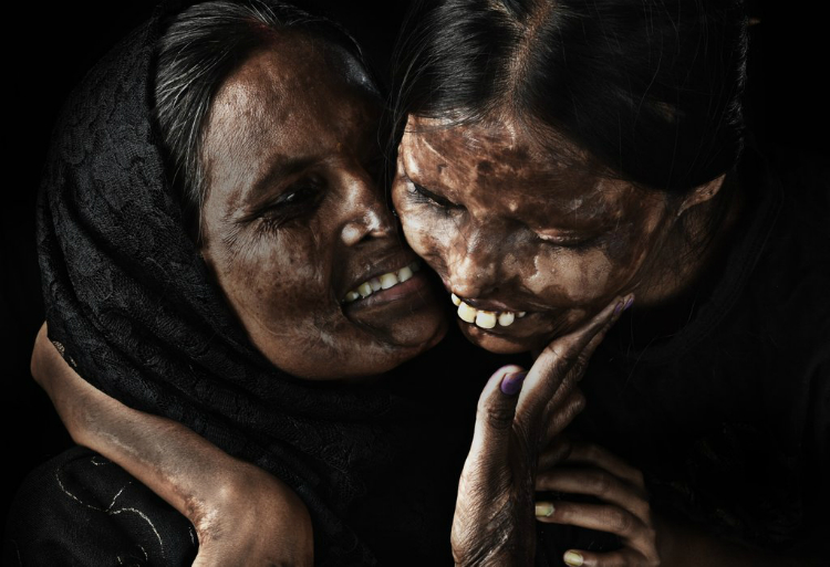 acid-attack-survivors-campaign-11.jpg